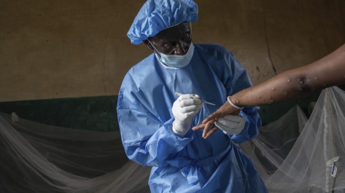 Un soignant traite une patiente atteinte du virus mpox à l'hôpital de Kamituga dans l'est de la RDC, le 4 septembre 2024. (Image d'illustration) AP - Moses Sawasawa